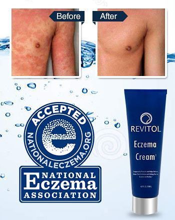 Revitol Eczema Therapy Cream- Healthy Skin