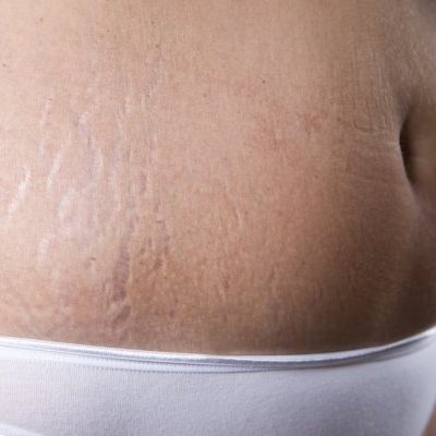 Stretchmark Therapy