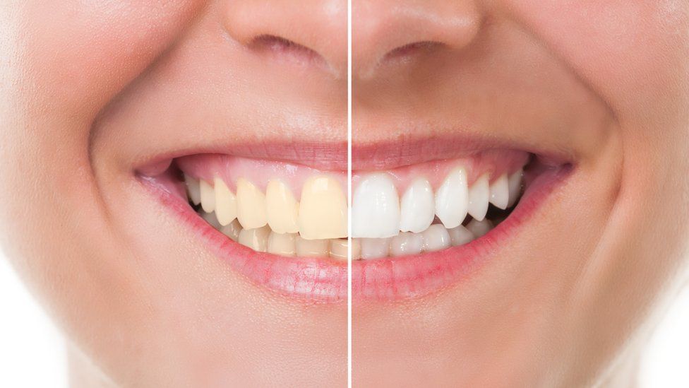 Why is Teeth Whitening so crucial?