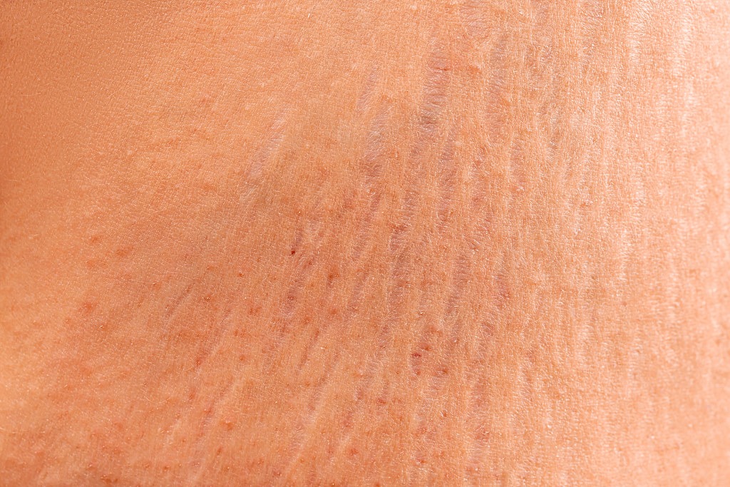 How to Treat Stretch marks on the body