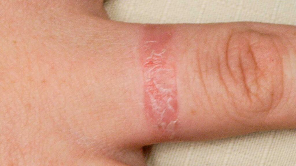 Random dry patch on skin - Contact dermatitis