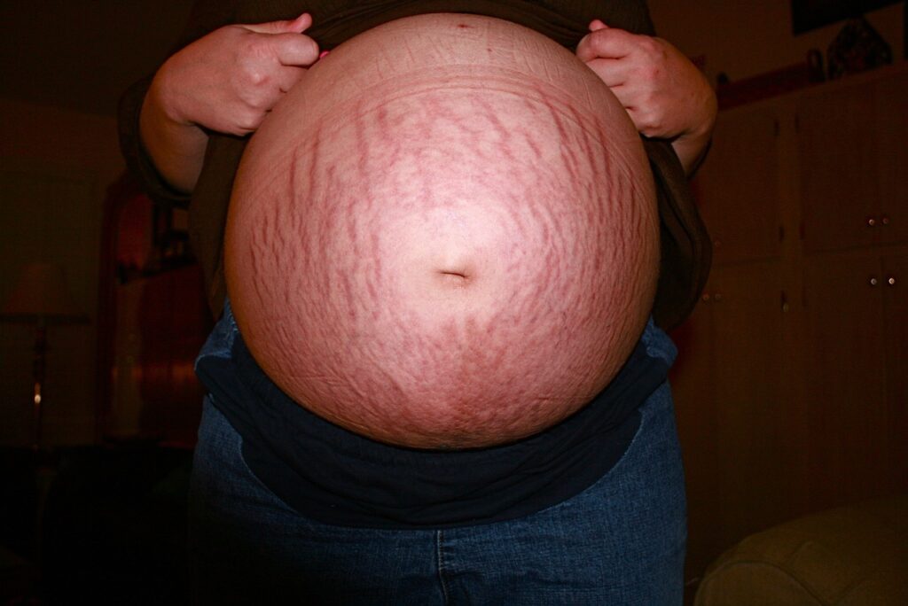Stretch marks on the body: Causes