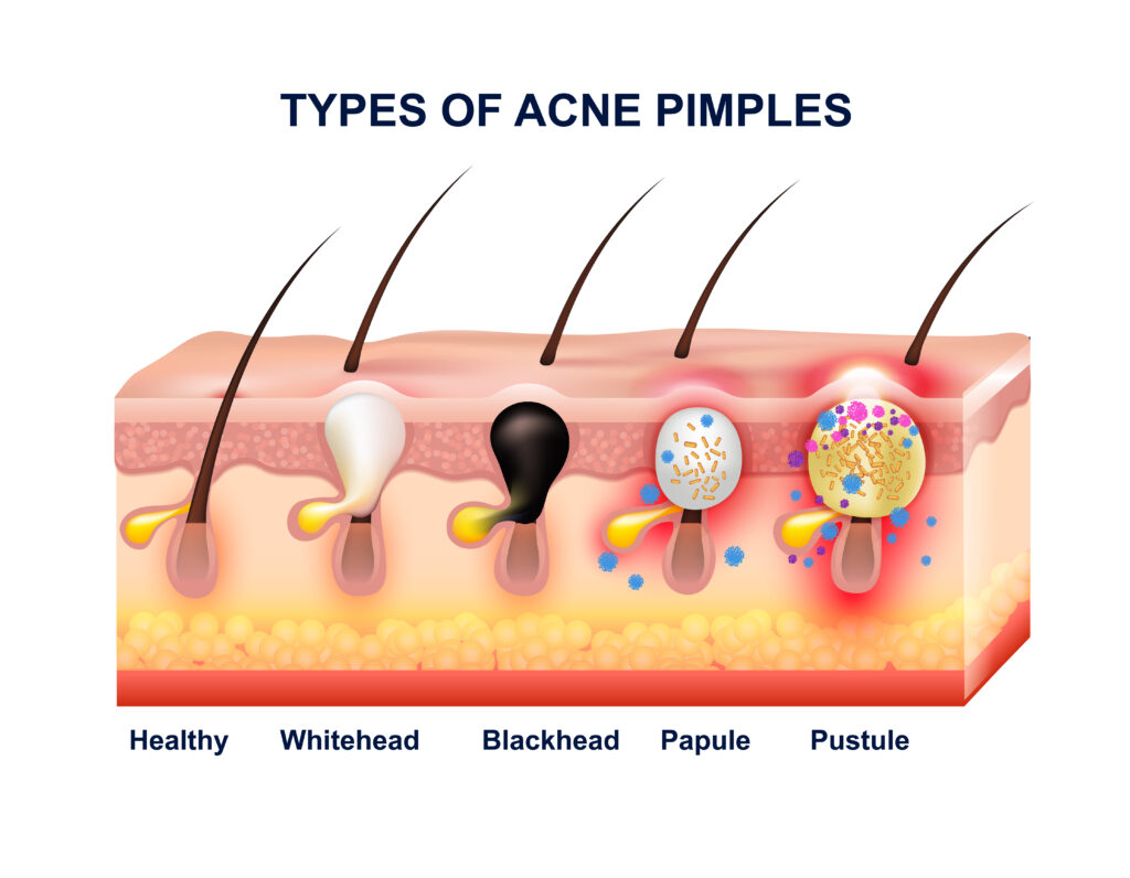 Factors that Cause Acne