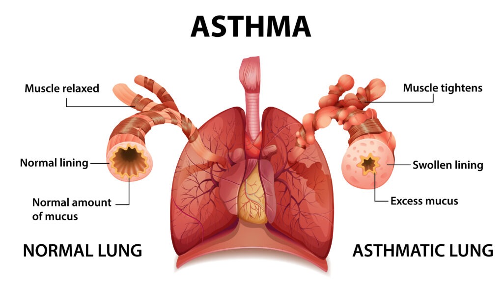 Breathing-related risks from smoking