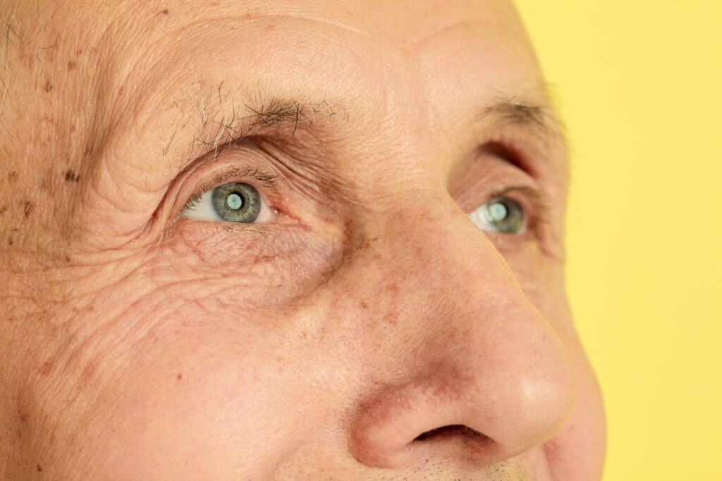 Home remedies for Age Spots