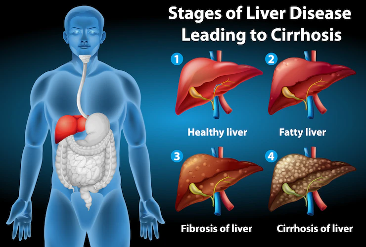 Nonalcoholic fatty liver disease: Causes