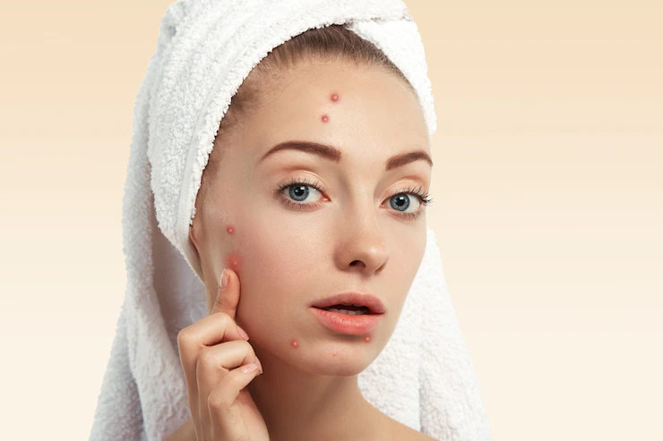 woman concerned about acne on face 