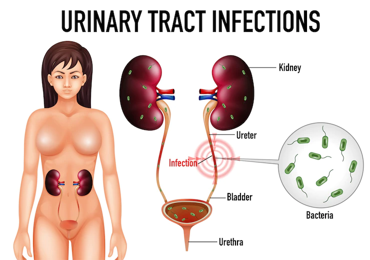 Who gets causes urinary tract infections?