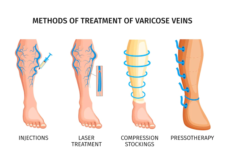 Treatments for Varicose Veins