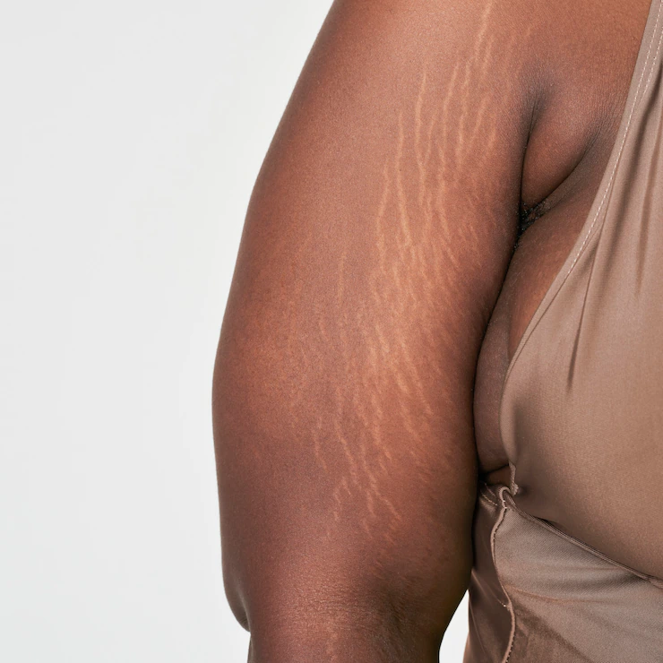 Symptoms of Stretch mark on the arm