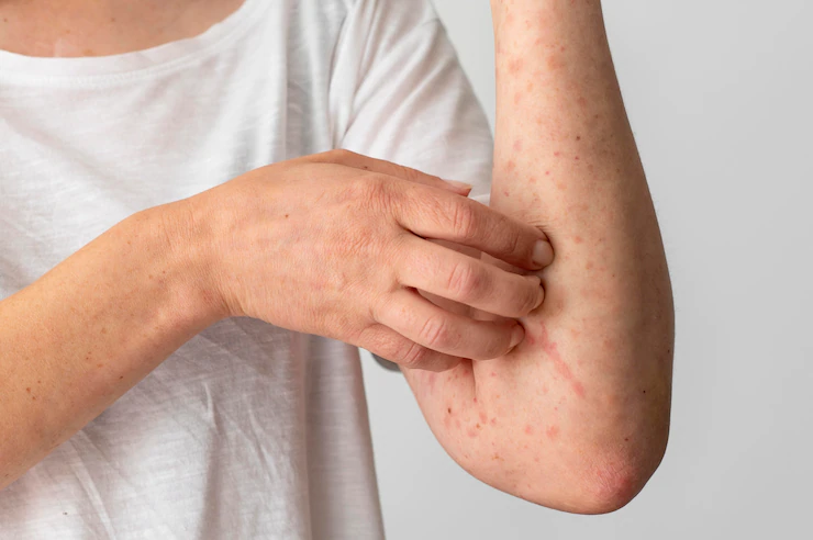 The Cause of psoriasis