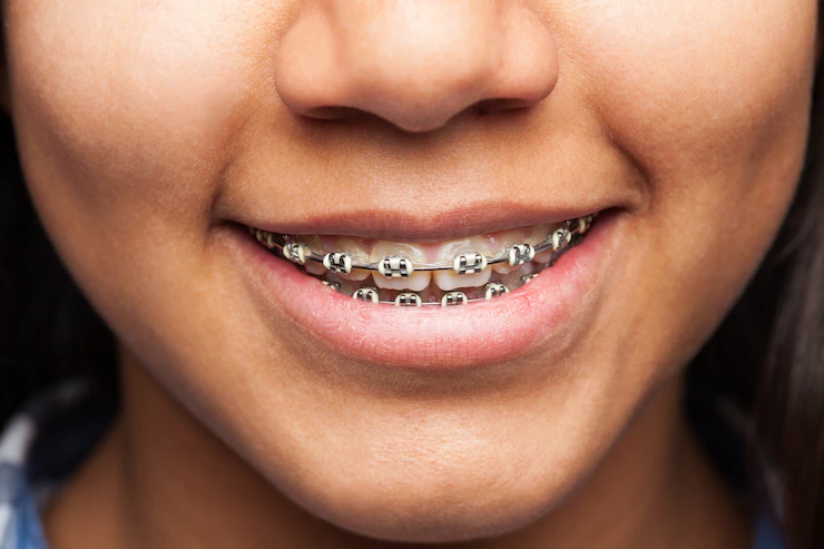 Types of Teeth braces: Traditional Metal Braces