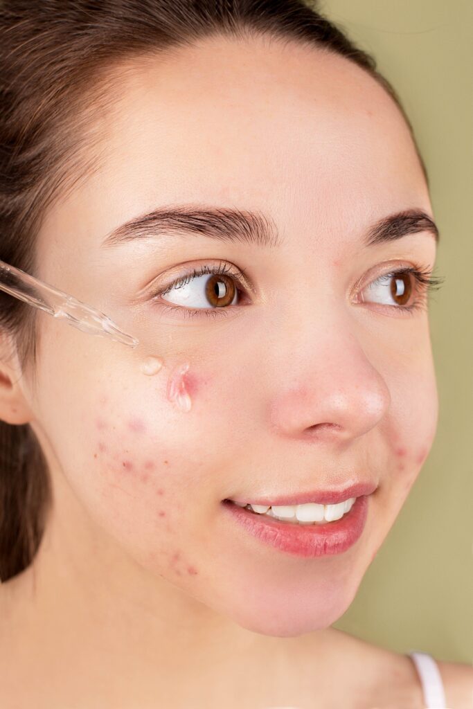 https://agphealthnbeauty.com/product/revitol-acne-scar-cream-skin-brightener/
