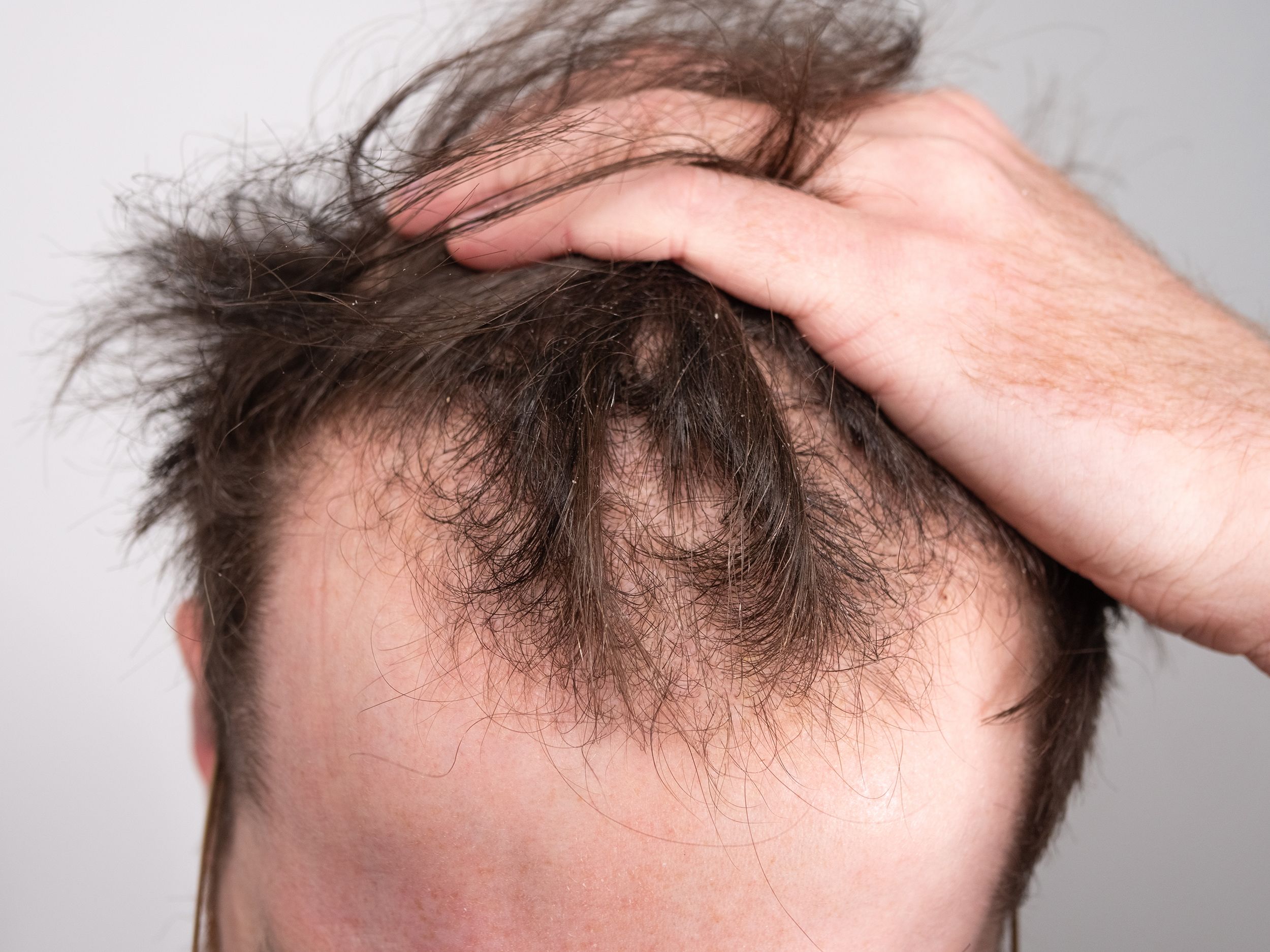 Transform Your Hair with Profolan: The Best Hair Loss Solution for Men